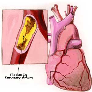 Arteriosclerosis Remedies, Treatment, Symptoms Arteriosclerosis Picture