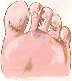 Remedies for Athletes Foot, Treatment, Causes Athletes Foot Picture