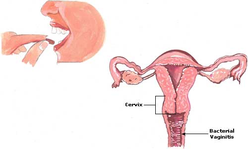 Vaginal Bacterial Infection Symptoms, Treatment, Cures Bacterial Vaginitis Picture