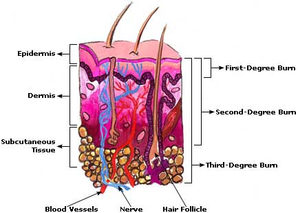 Home Remedies for Burns, Treatment, Relief Burns Picture