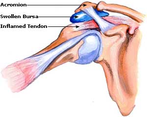 Treatment for Bursitis, Symptoms, Relief Bursitis Picture