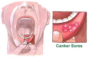 Home Remedies for Canker Sores, Causes, Relief Canker Sores Picture
