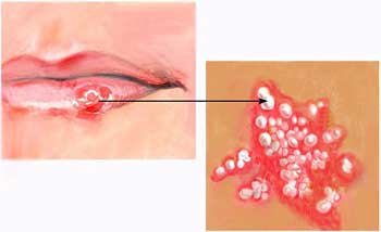 Cold Sores Picture