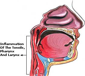 Common Cold Remedies, Treatment, Symptoms Common Cold Picture