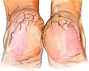 Cracked Heels  Picture