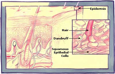 Dandruff Picture