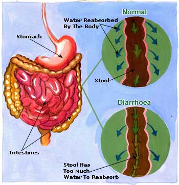 Causes of Diarrhea, Remedies, Treatment Diarrhoea Picture