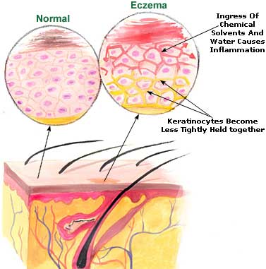 Eczema Picture