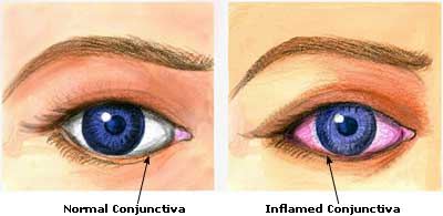 Eye Infection Picture
