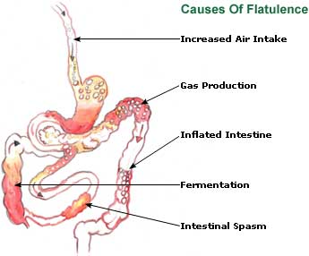 Natural Remedies for Flatulence, Causes, Treatment Flatulence Picture