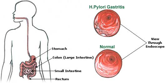 Natural Remedies for Gastritis, Causes, Symptoms Gastritis Picture