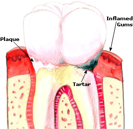 Treatment for Gingivitis, Remedies, Causes Gingivitis Picture