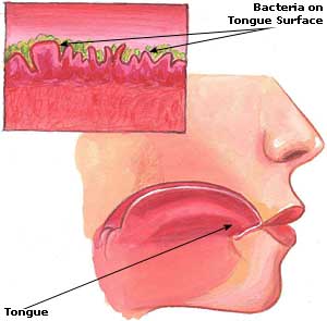 Home Remedies for Indigestion, Causes, Treatment Halitosis Picture
