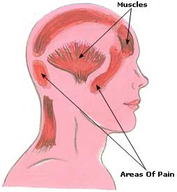 Natural Headache Remedies, Relief, Cure Headache Picture