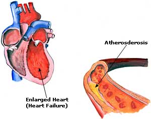 High Blood Pressure Home Remedies, Treatment, Causes High Blood Pressure Picture