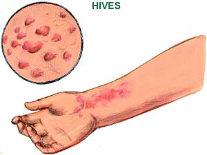 Natural Remedies for Hives, Causes, Treatment Hives Picture