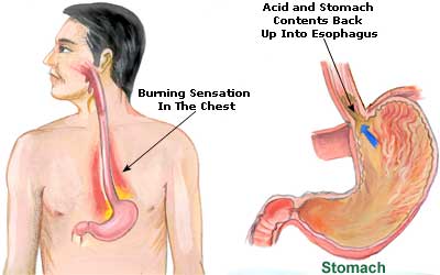 Natural Remedies for Hyperacidity and Heartburn Hyperacidity and Heartburn Picture