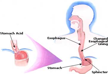Home Remedies for Indigestion, Causes, Treatment Indigestion Picture