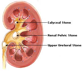 Kidney Stones Treatment, Symptoms, Prevention Kidney Stones Cure