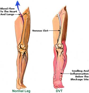 Cause of Leg Cramps, Remedies, Relief Leg Cramps Picture