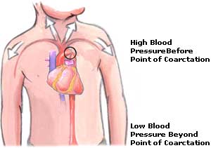 Low Blood Pressure Symptoms, Treatment, Causes Low Blood Pressure Picture