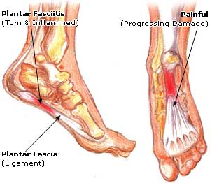 Plantar Fasciitis Picture