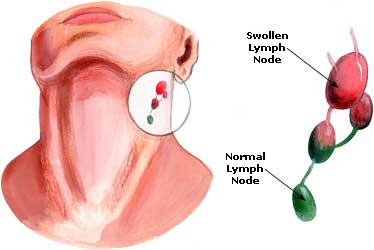 Sore Throat Remedies, Treatment, Cures Sore Throat Picture