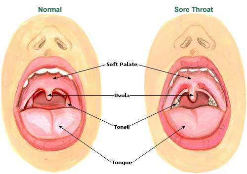 Sore Throat Remedies, Treatment, Relief Sore Throat Picture