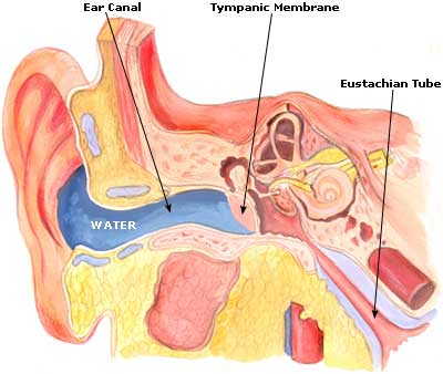 Swimmers Ear Picture