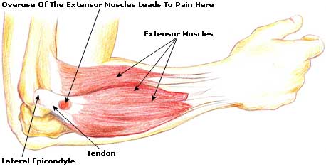 Tennis Elbow Treatment, Cure, Remedies Tennis Elbow Causes