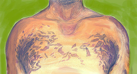 Tinea Versicolor Rash