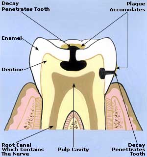 Toothache Picture