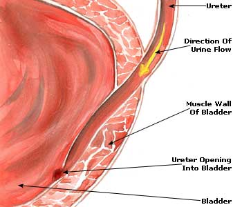 Urinary Infection Remedies, Causes, Treatment, Symptoms Urinary Tract Infection Picture