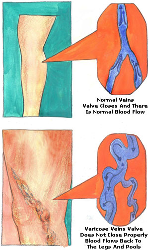 Varicose Veins Picture