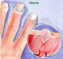 Warts  Picture