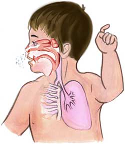 Whooping Cough  Picture